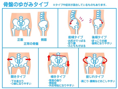 治す 方法 骨盤 前 傾 骨盤の後傾を改善！後傾タイプの原因と筋トレ！